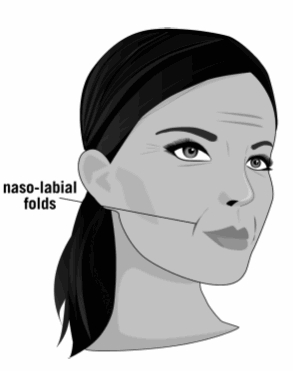 Naso-labial folds