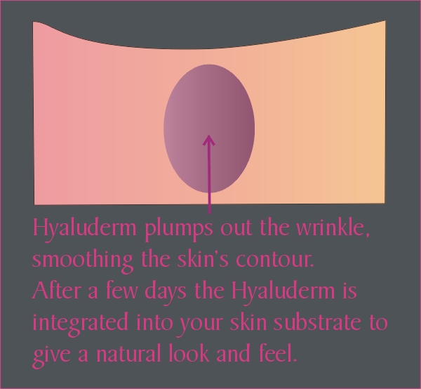 Wrinkle after treatment