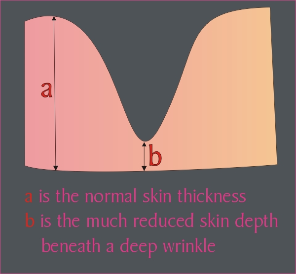 Wrinkle before treatment